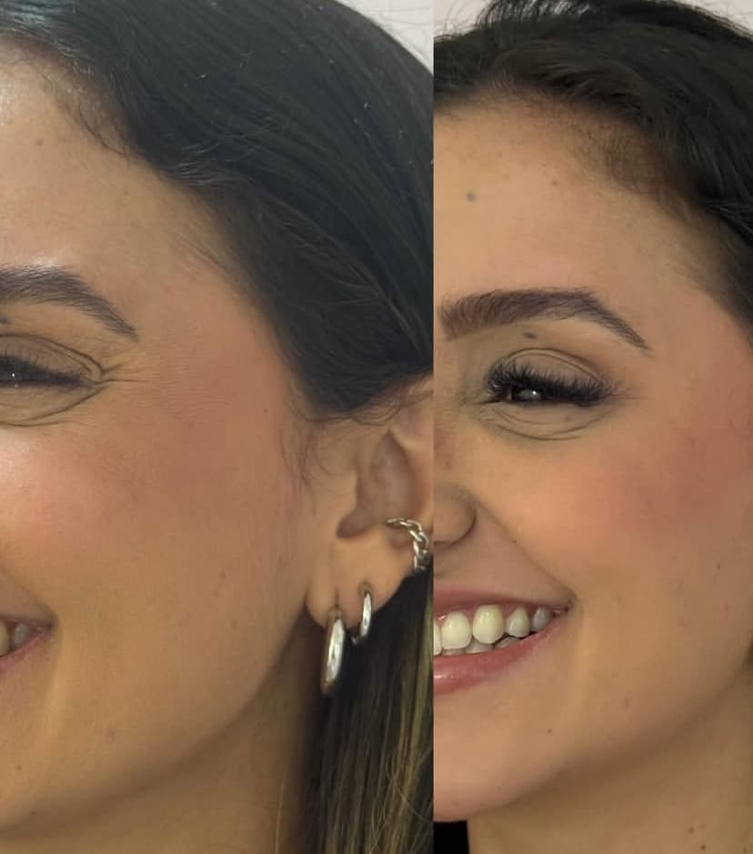 Antes e depois — Botox