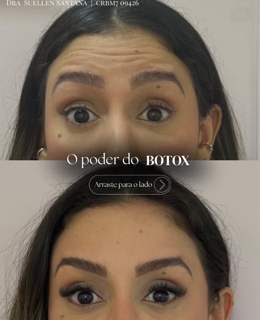 Antes e depois — Botox