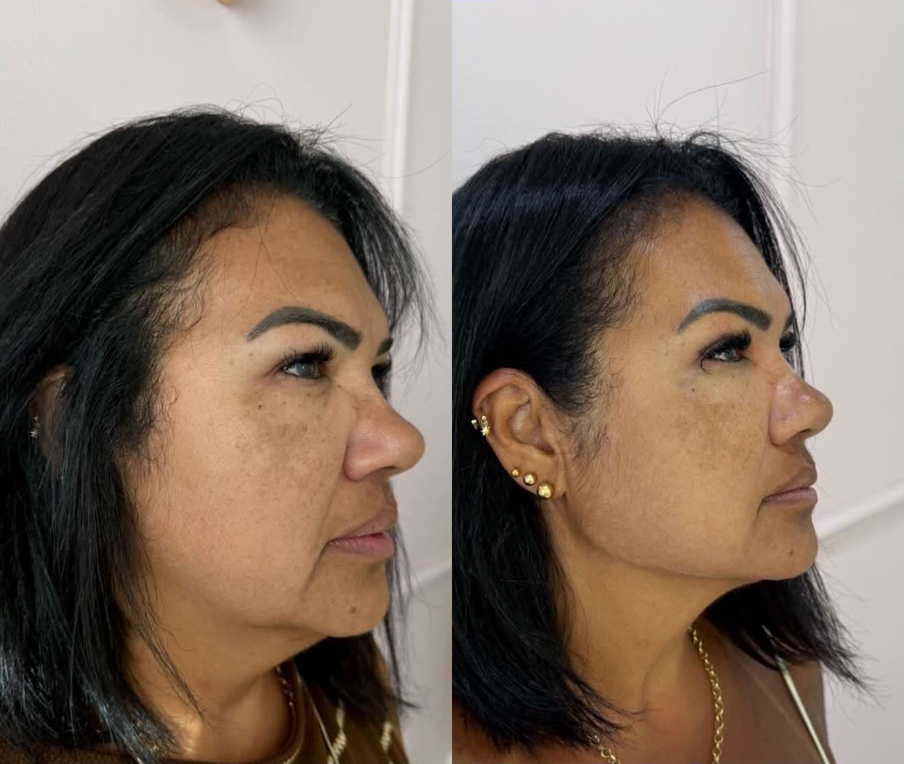 Antes e depois — Preenchimento de Malar, Mandíbula, Bigode Chinês e Marionete