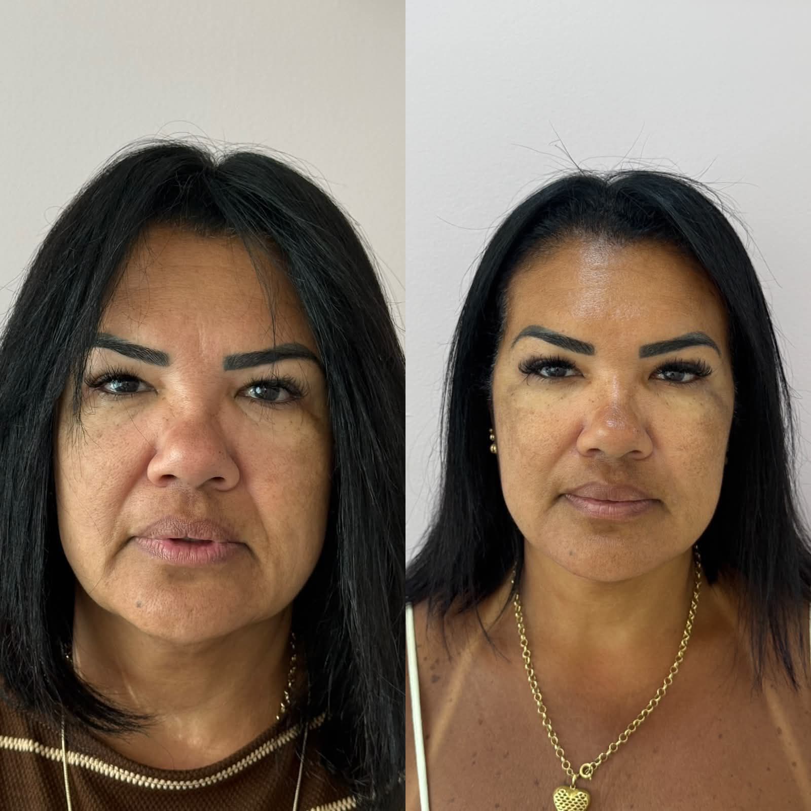Antes e depois — Preenchimento de Malar, Mandíbula, Bigode Chinês e Marionete