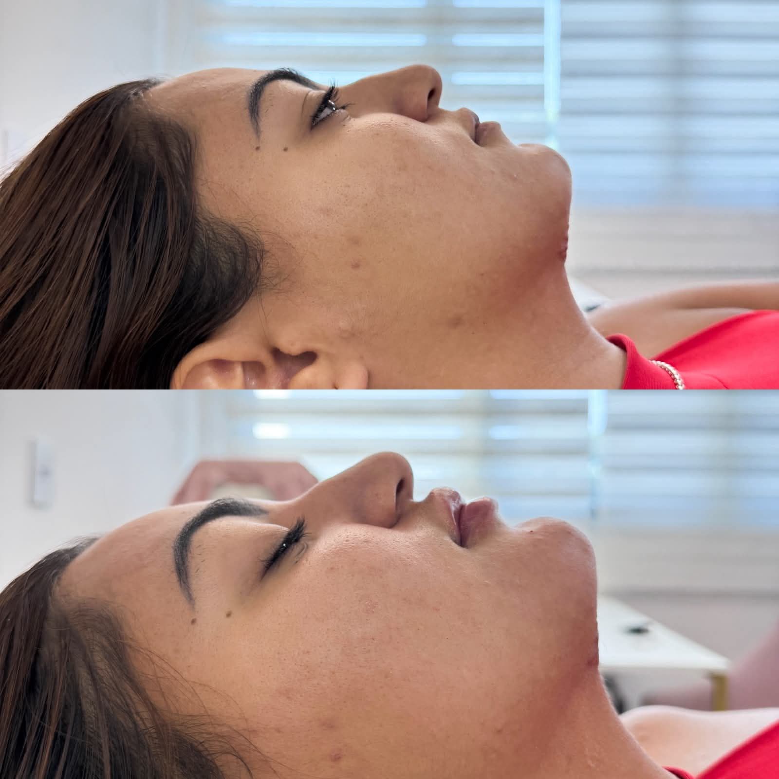 Antes e depois — Preenchimento de Mento e Labial