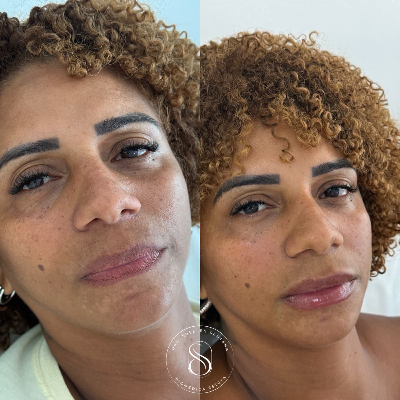 Antes e depois — Preenchimento de Olheiras e Labial