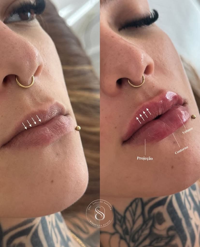 Antes e depois — Preenchimento Labial