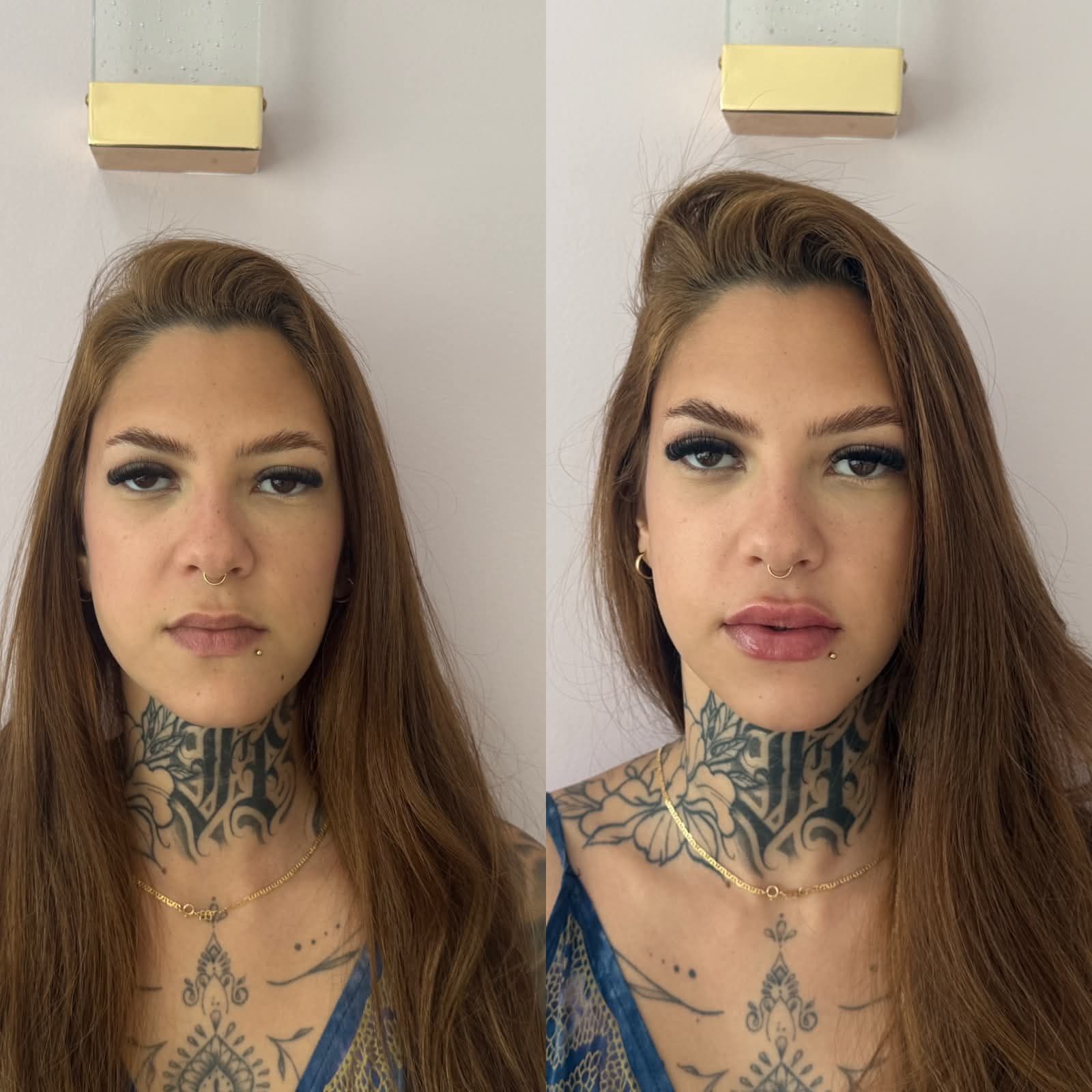 Antes e depois — Preenchimento Labial